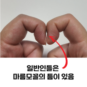 폐암 자가진단 핑거클러빙